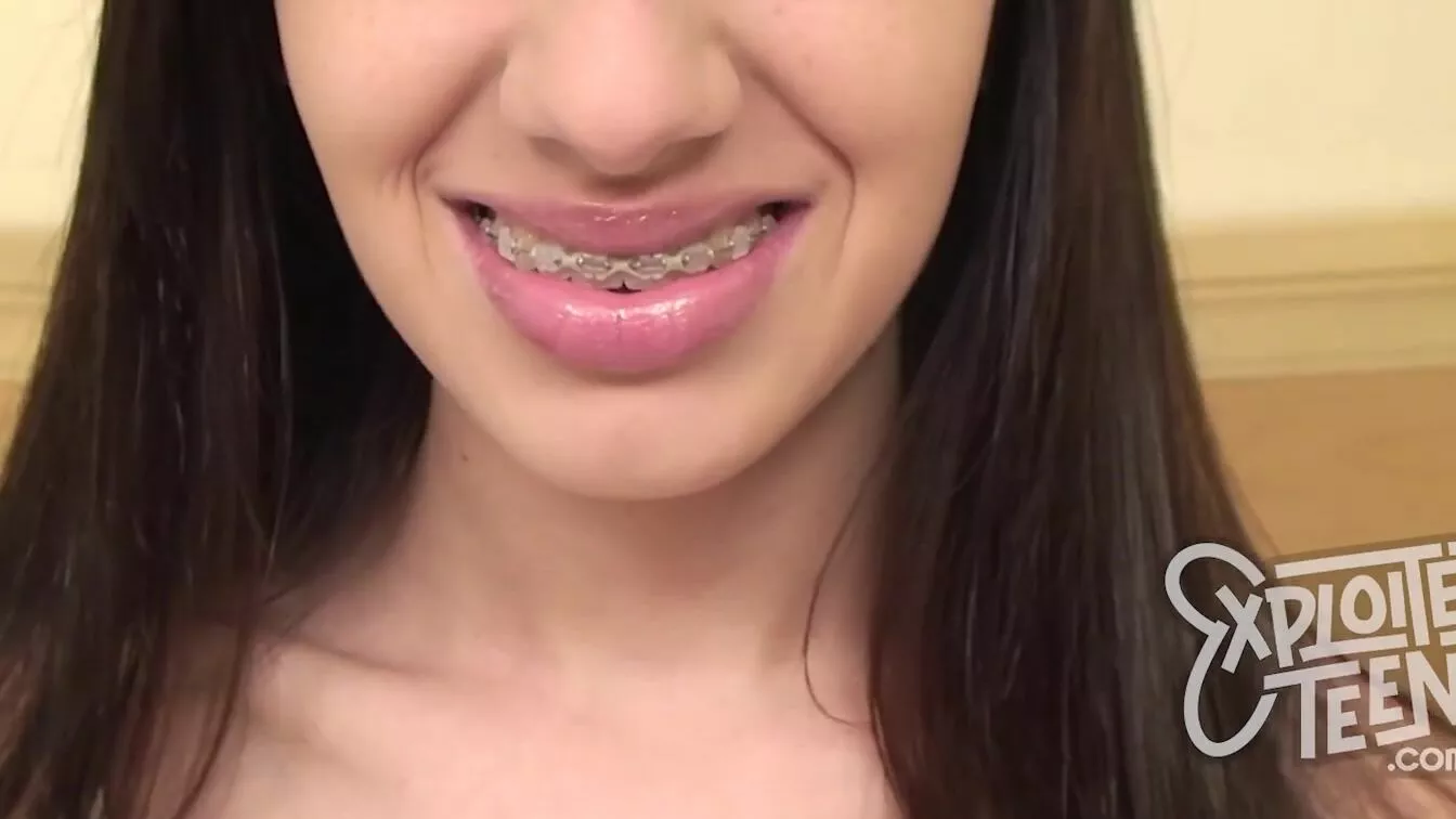 avril ramonalavigne recommends exploited teens 18 braces pic